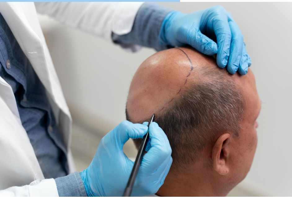 What Makes FUE Hair Transplant in Raleigh a Preferred Choice