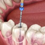 Advanced Root Canal Treatment: How Modern Technology Is Changing the Patient Experience