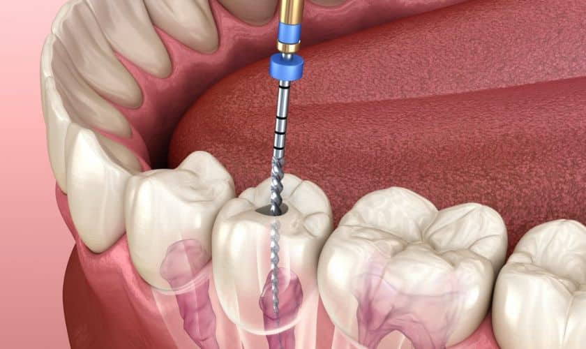 Advanced Root Canal Treatment: How Modern Technology Is Changing the Patient Experience