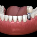 Dental Implants and Lifestyle: How Oral Health Impacts Confidence and Living