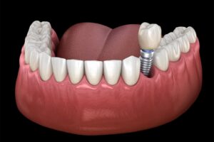 Dental Implants and Lifestyle: How Oral Health Impacts Confidence and Living