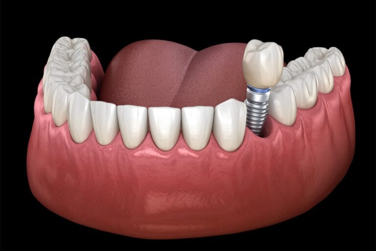 Dental Implants and Lifestyle: How Oral Health Impacts Confidence and Living